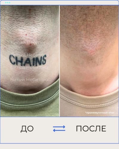 Удаление татуировки